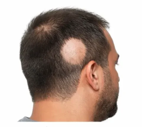 Alopecia Areata